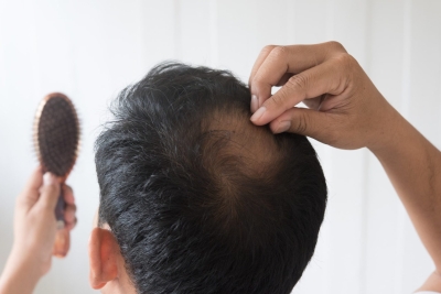 3 dingen die goed zijn om te weten voordat je een haartransplantatie ondergaat